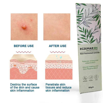 Ecze+ Anti Fungal And Psoriasis Spray Buy 1 Get 1 )